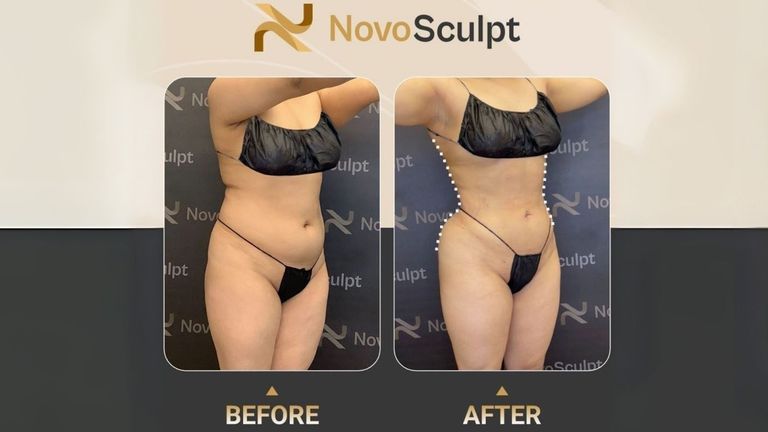 Before and after photo showcasing a body transformation with NovoSculpt fat removal technology. The image displays visible improvement in body contouring, highlighting the effectiveness of NovoSculpt's non-invasive treatment.