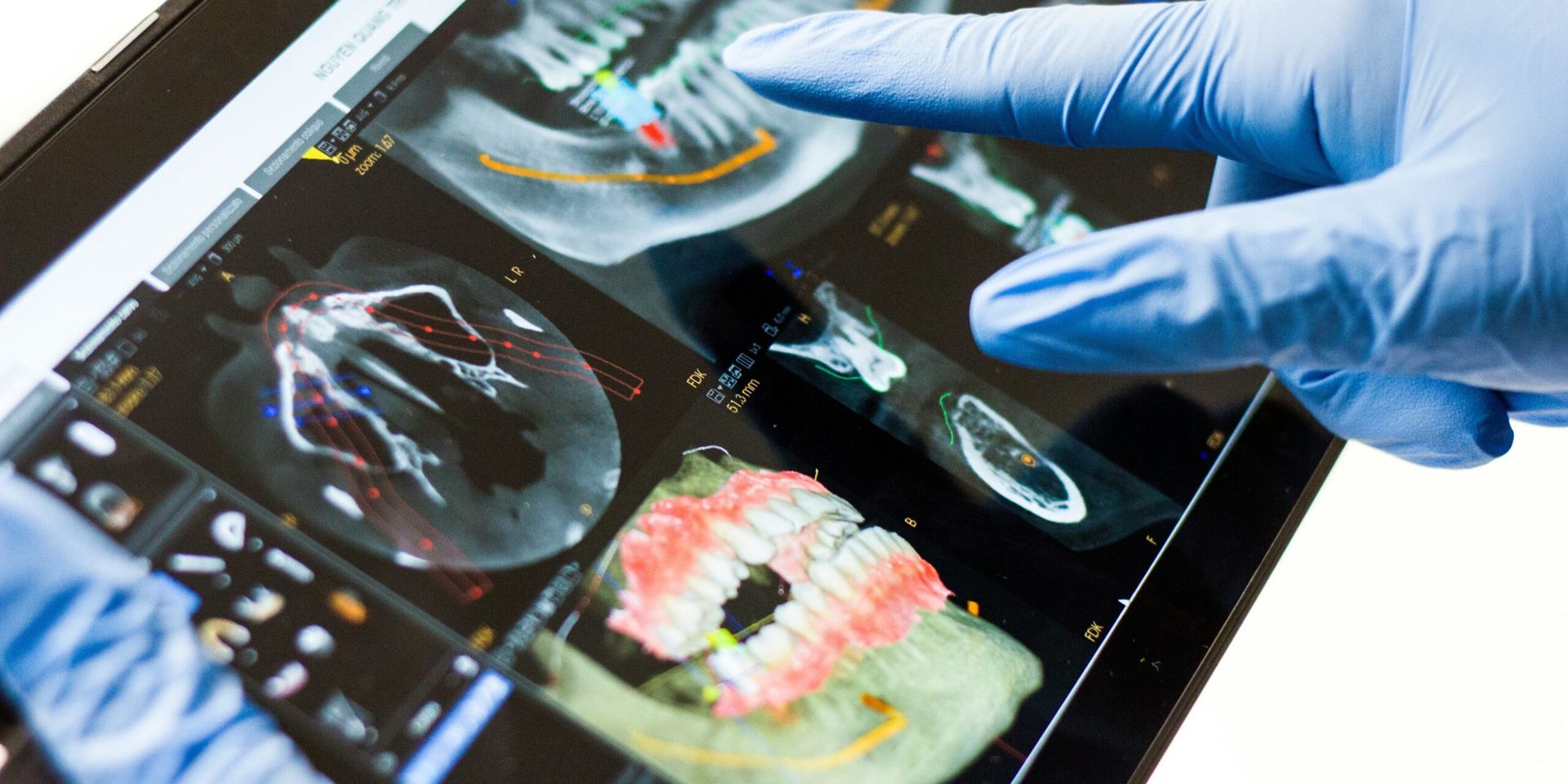 Mayo Clinic Unveils AI Tool to Detect Surgical Site Infections from Patient Photos