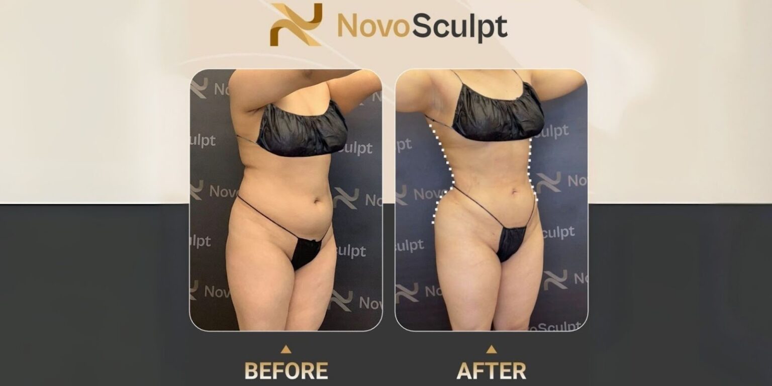 Before and after photo showcasing a body transformation with NovoSculpt fat removal technology. The image displays visible improvement in body contouring, highlighting the effectiveness of NovoSculpt's non-invasive treatment.